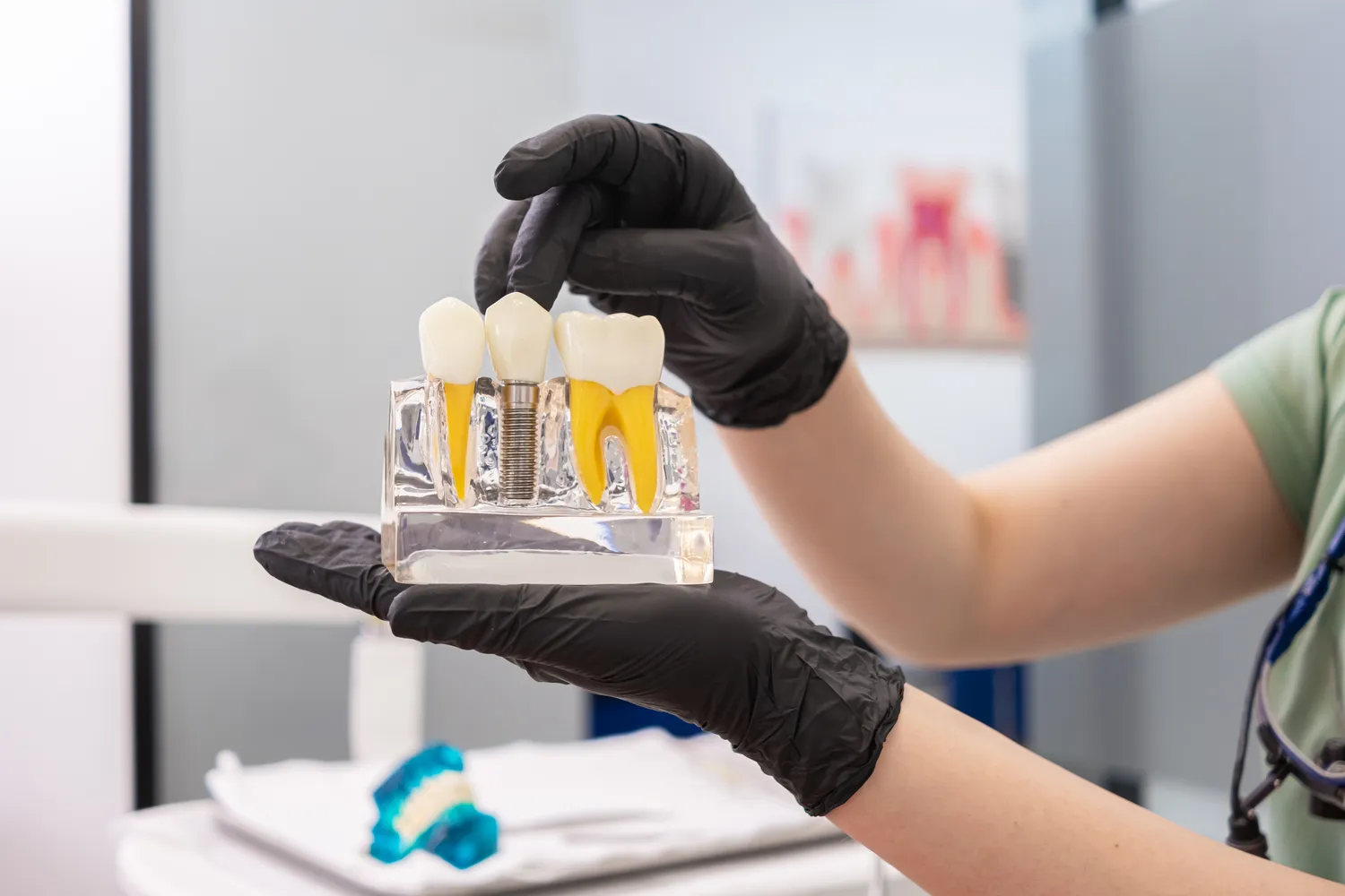 Ile kosztują implanty górnej szczęki?