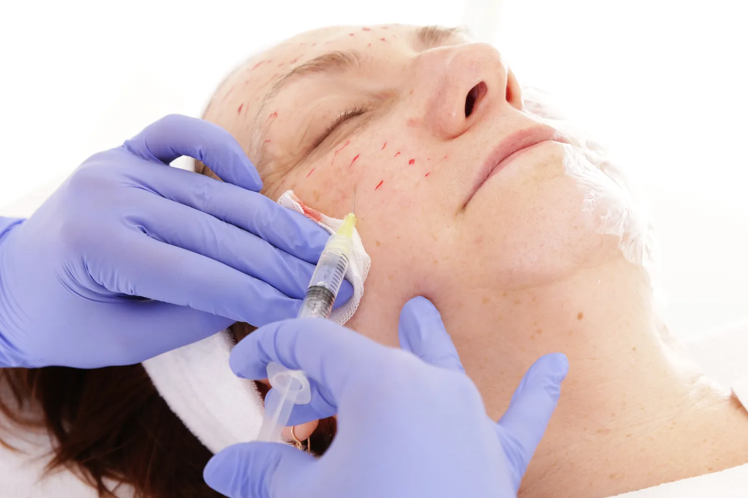 Co na worki pod oczami medycyna estetyczna?